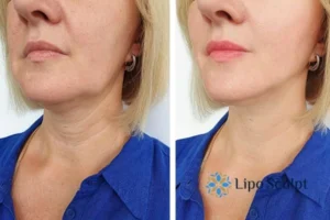 Double chin before and after Hi-Fu treatment 4 Book your double chin treatment Bournemouth today! We are here to help!