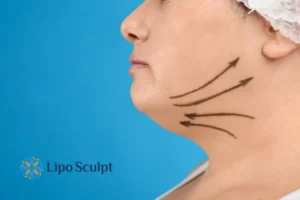 Double chin before and after Hi-Fu treatment 3 Boost your confidence with a Double chin treatment Bournemouth
