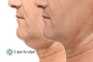 Double chin before and after Hi-Fu treatment 2 Double chin treatment Bournemouth from Lipo Sculpt - feel more confident today!