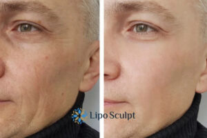 How to Fight Aging Symptoms 3 Fight Aging Symptoms Bournemouth With HIFU and Morpheus8 Today!