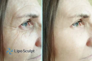 How to Fight Aging Symptoms 2 Do you want to Fight Aging Symptoms Bournemouth? Contact Lipo Sculpt today!