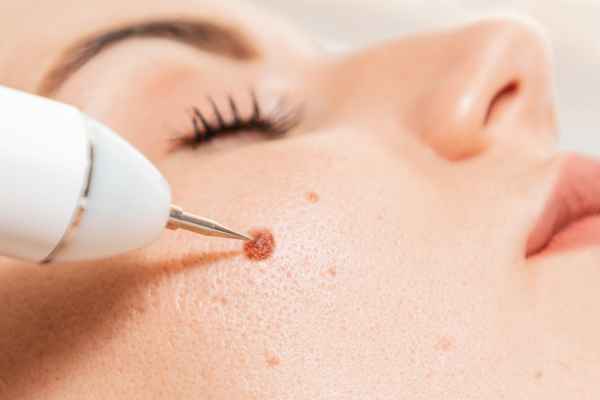CryoPen: 5 Skin Concerns It May Be Used to Treat 3 What actually happens during a CryoPen treatment Bournemouth?