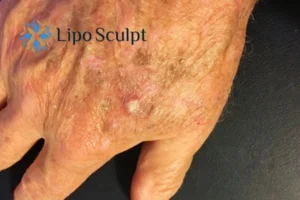 Best Actinic Keratoses Removal 2 Improve your wellbeing and health with Actinic Keratoses Bournemouth removal.treatment
