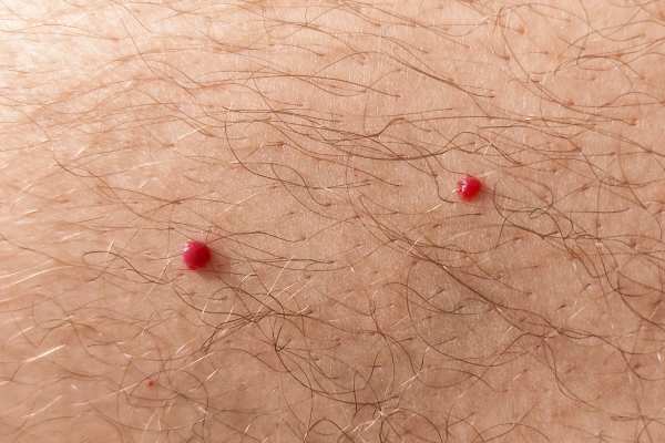 CryoPen: 5 Skin Concerns It May Be Used to Treat 2 cherry angioma removal Bournemouth