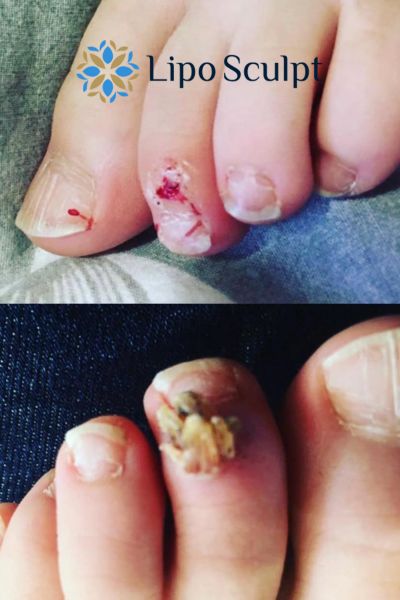 Wart removal customer results from Lipo Sculpt Bournemouth