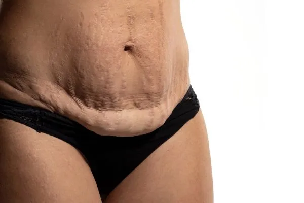 Lost the Weight but Not the Loose Skin? 1 image of womans stomach after weight loss showing loose skin Bournemouth